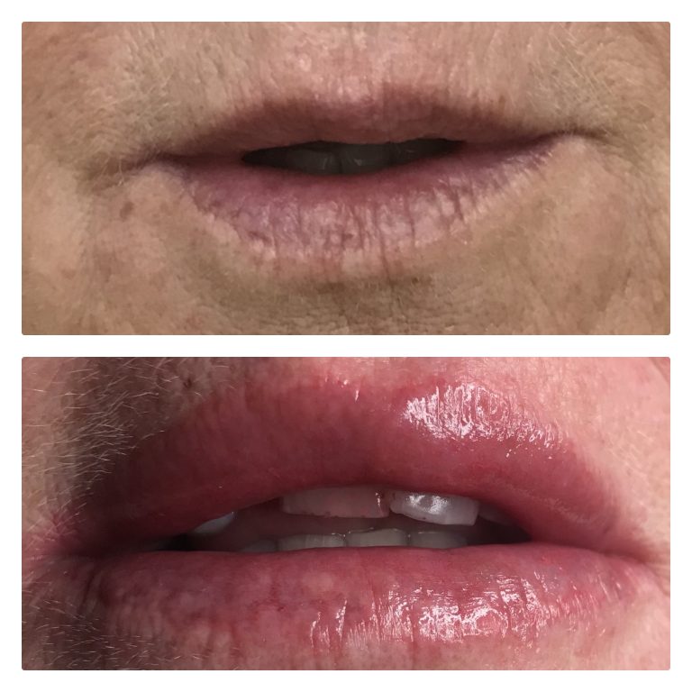 B3FB30B7-D240-4F7E-A91C-2B9B944B90A5 Lip blush